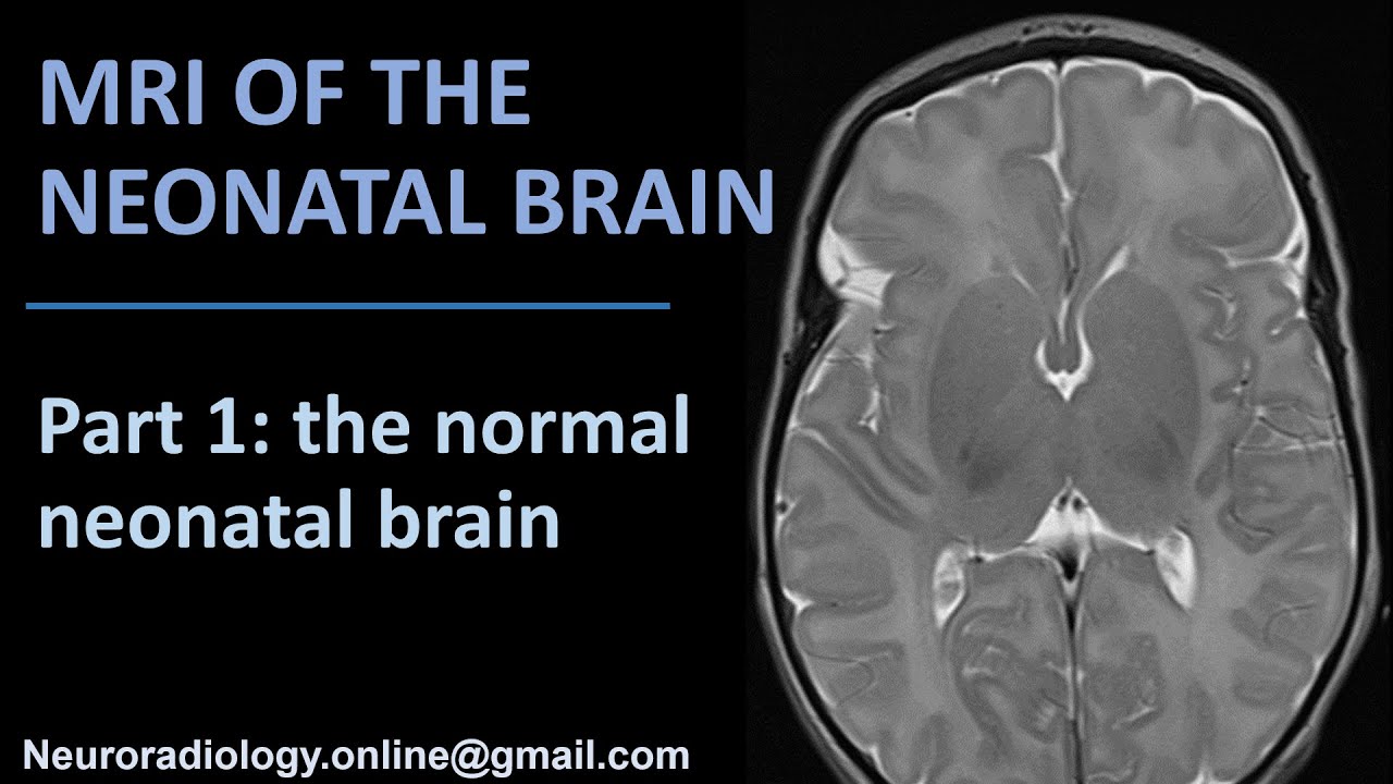 MRI of the Neonatal Brain, part 1: the normal neonatal brain.