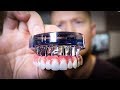 DENTURES vs Dental IMPLANTS Full Mouth Rehabilitation - See the Smile Transformation!