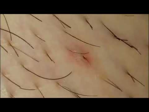 Viermi Sub Piele Capre Salbatice Larve Sub Piele