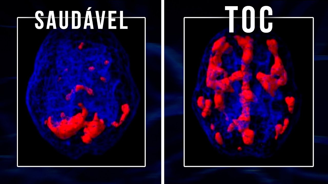 COMO É O CÉREBRO DE QUEM TEM TOC