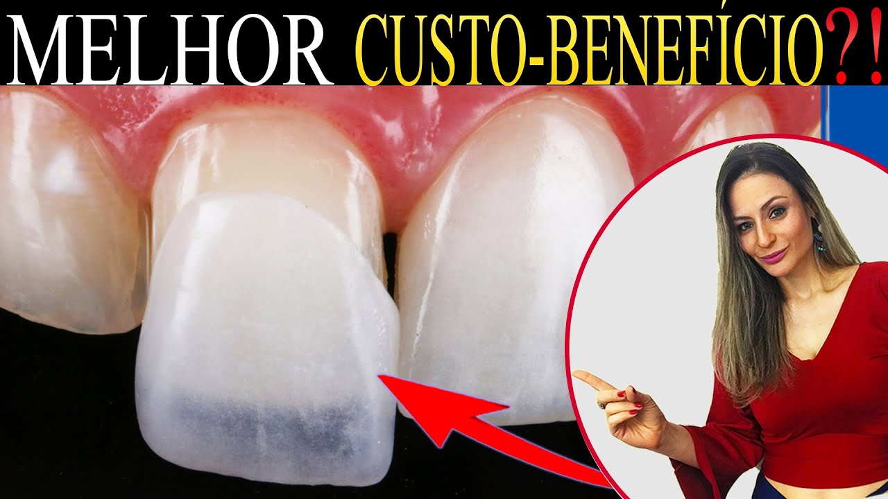 O que é melhor, Faceta Dental, Lente de Contato de Porcelana ou Resina, qual melhor custo-benefício