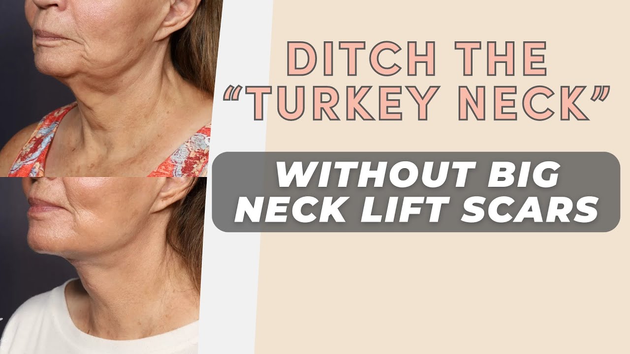 T-Z Plasty Update: Tightening Necklines for Men & Women