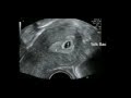 Ultrasound 5 Weeks Gestation |Early pregnancy scan |