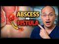 “Perianal Abscess & Fistula: Diagnosis and Management Made Simple”