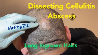 Large, boggy, tender mass on scalp drained that produces long ingrown hairs. Incision and drainage.