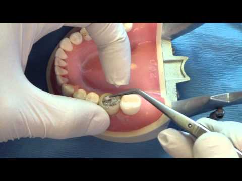Odbudowa korony zęba za pomocą amalgamatu - wskazówki - część 2