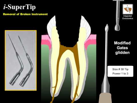 Removal of broken instrument