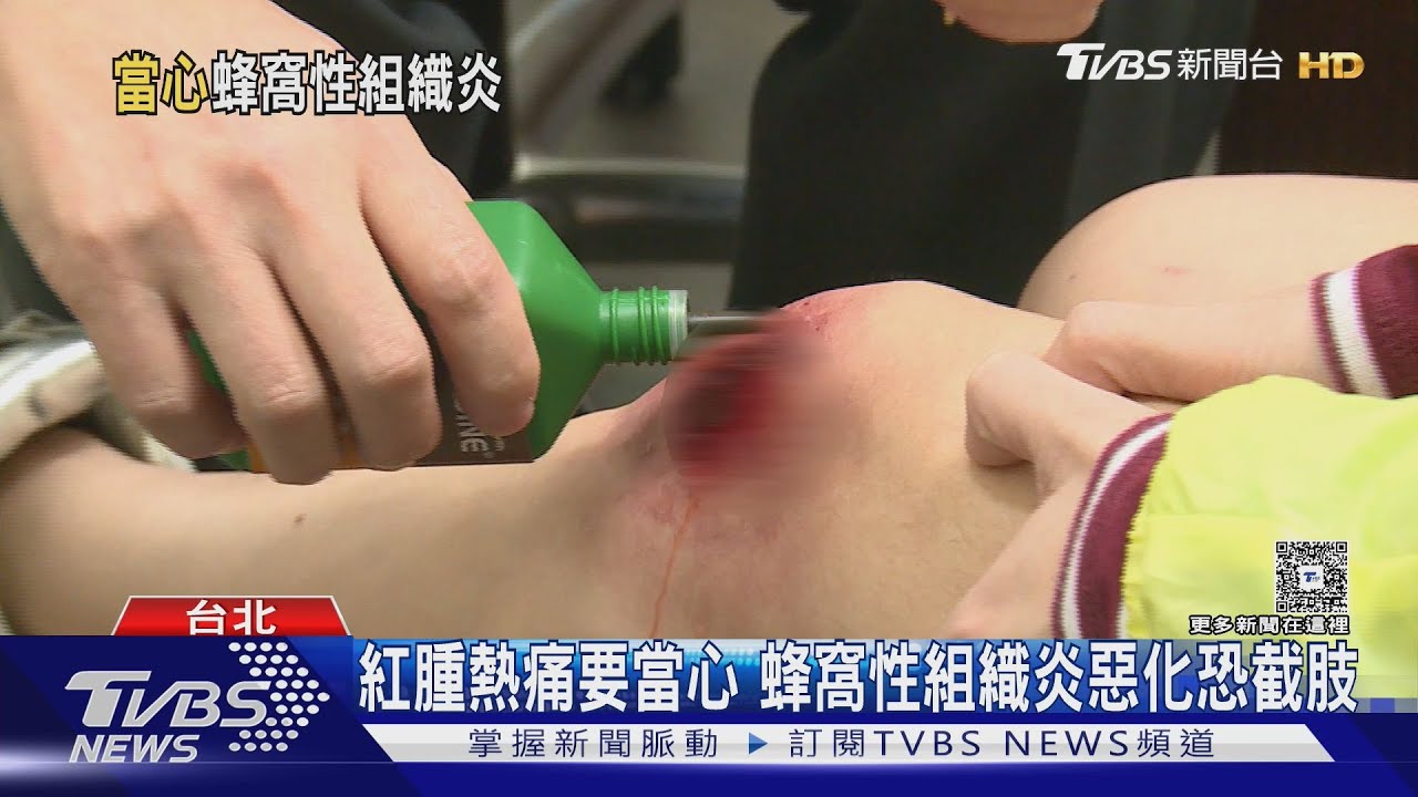 蜂窩性組織炎別輕忽!醫師示警:出現「這五種」狀況 提高警覺!
