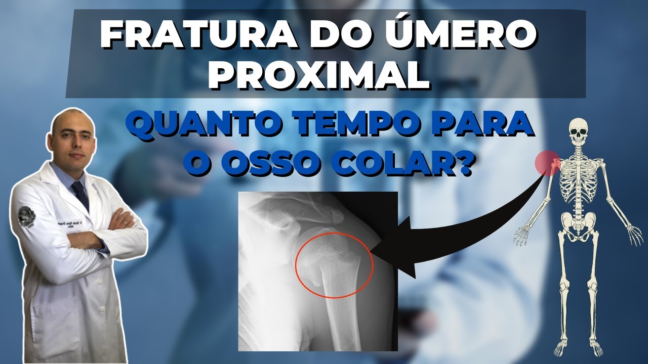 FRATURA UMERO PROXIMAL: QUANTO TEMPO PARA O OSSO COLAR TEMPO DE RECUPERAÇÃO
