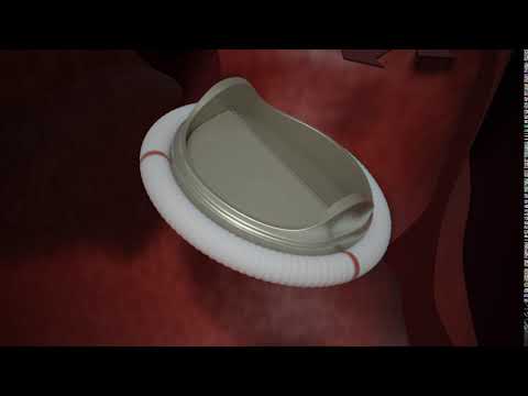 Mechanical replacement heart valve