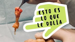 Neuroma de Morton: calambres en la planta del pie (Testimonio).