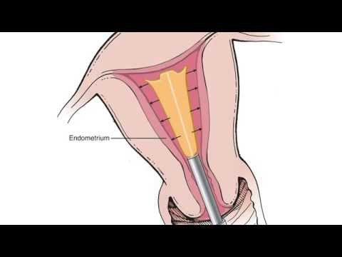 endometrium abláció és fogyás)