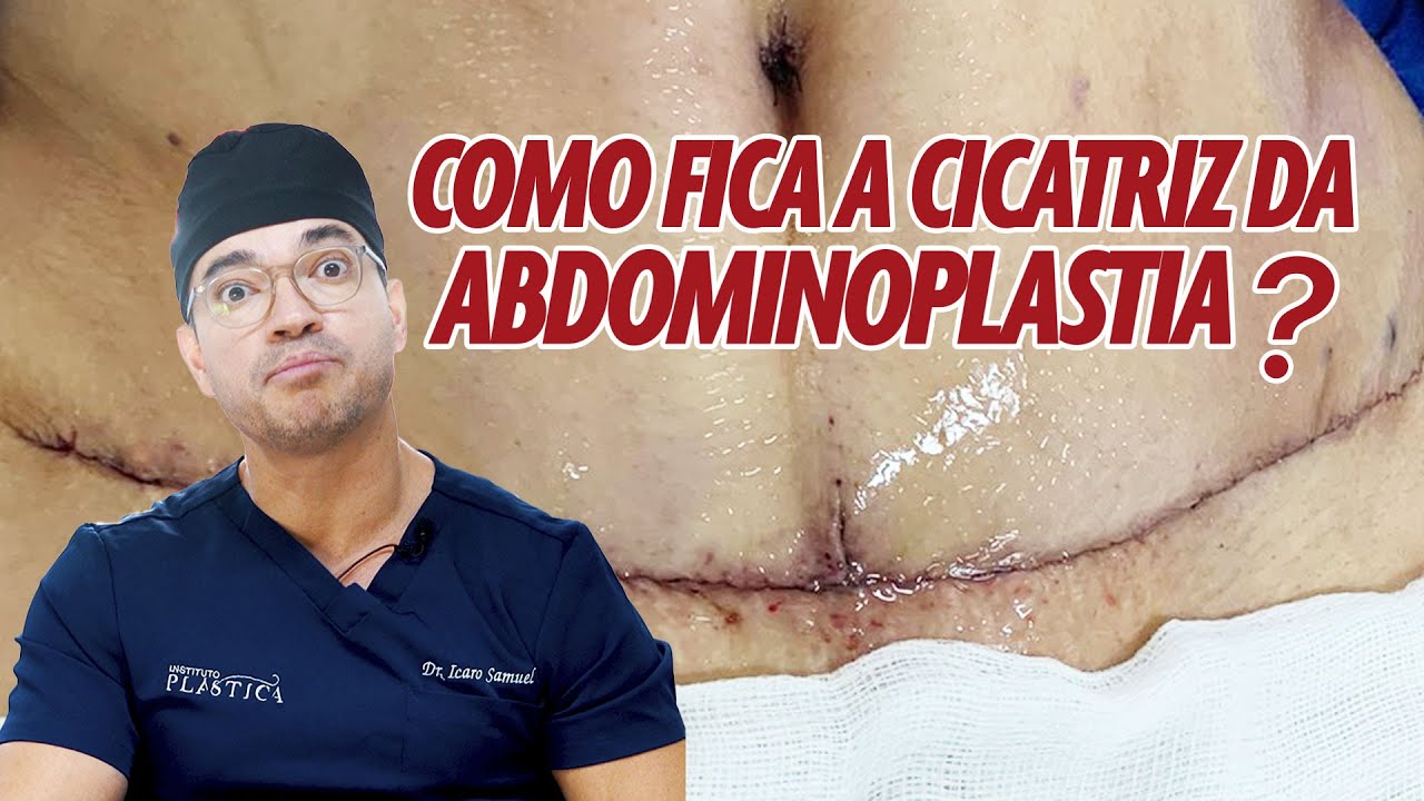 COMO FICA A CICATRIZ DA ABDOMINOPLASTIA? CIRURGIA PLASTICA