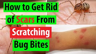 How to Get Rid of Scars from Scratching Bug Bites | Health Intent