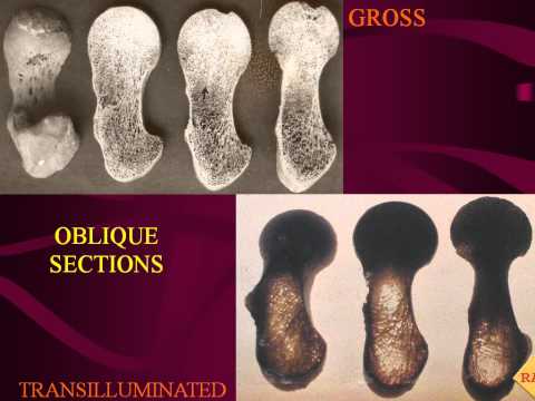 Trabecular Patterns - A reflection of bone vitality
