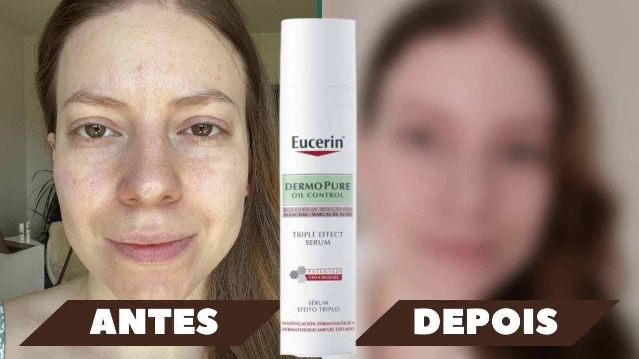 Resenha EUCERIN DermoPure Sérum Efeito Triplo, 8 meses de uso | Resultados em manchas pós acne