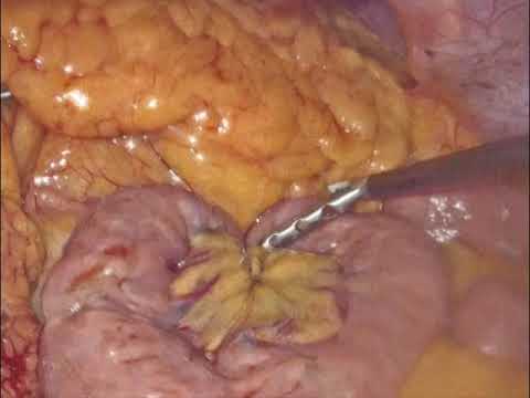 Single Anastomosis Sleeve Jejunal Bypass (SASJ)