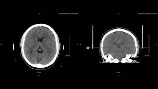 Unremarkable Non-Contrast CT Axial Scan - Example 3