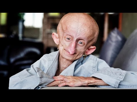 Teen TikToker With Rare Disease Dies