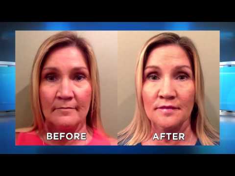 Operation Hot Lips with Jessica Canseco - Plump Lips - Nurse Jamie on The Doctors