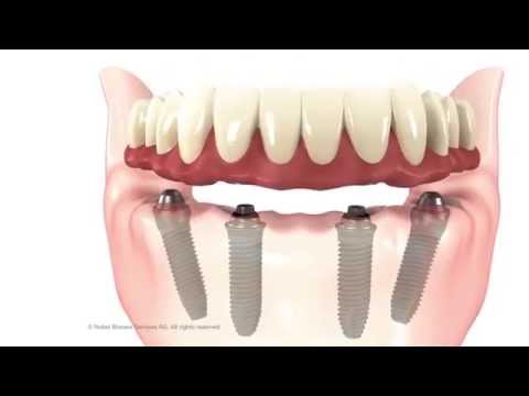 All on 4 dental implant - FMS Dental Hospital