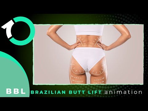Hourglass Brazilian Butt Lift (BBL) - Surgical Procedure - One Clinic Patient Review Video