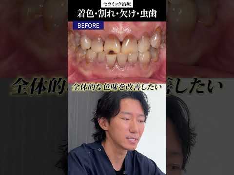 ひび割れ/虫歯/変色この状態からでもセラミックできれいな歯に#セラミック治療