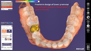 Medit i500 - Freeform design of lower premolar / построение нижнего премоляра с нуля в Exocad