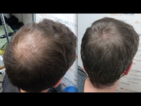 2501 FU's. Hair Transplant by FUE Technique. Injerto capilar. Crown. 1032/2013