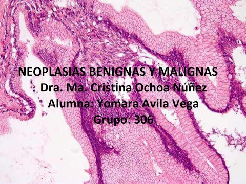 NEOPLASIAS  BENIGNAS Y MALIGNAS YOMARA AVILA VEGA  GRUPO: 306