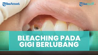 Apakah Gigi Berlubang Bisa Dilakukan Bleaching? Begini Jawaban dan Penjelasan Dokter