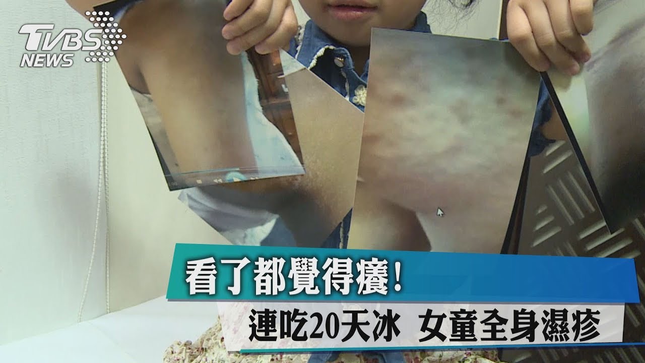 看了都覺得癢!連吃20天冰 女童全身濕疹