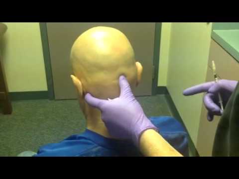 Botox for Migraine by Dr Andrew Blumenfeld