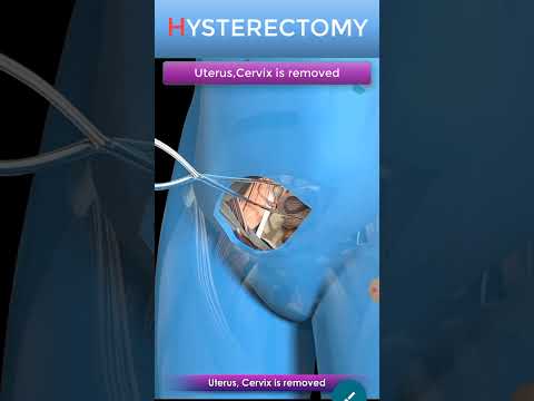 Abdominal Hysterectomy Procedure Short view #shorts