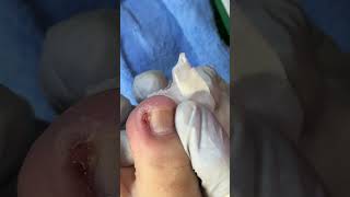 Ep_8691 Big ingrown toenail removal 👣 หนูดูเล็บ! 😅 (clip from Thailand)
