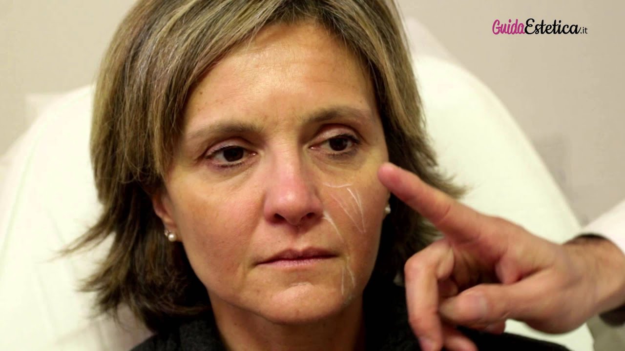 Watch Now Come ringiovanire e dare armonia al viso grazie al filler Come ringiovanire e dare armonia al viso grazie al filler