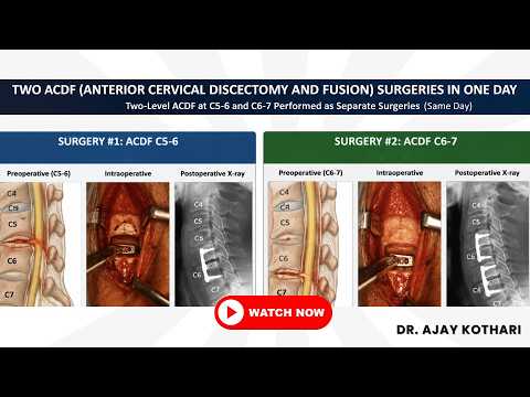 Patient Testimonials | Dr. Ajay Kothari - Minimally invasive endoscopic, scoliosis & Spine Surgeon | Shivaji Nagar, Pune