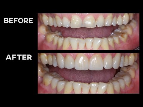 MY TEETH BEFORE vs AFTER