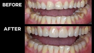 MY TEETH BEFORE vs AFTER