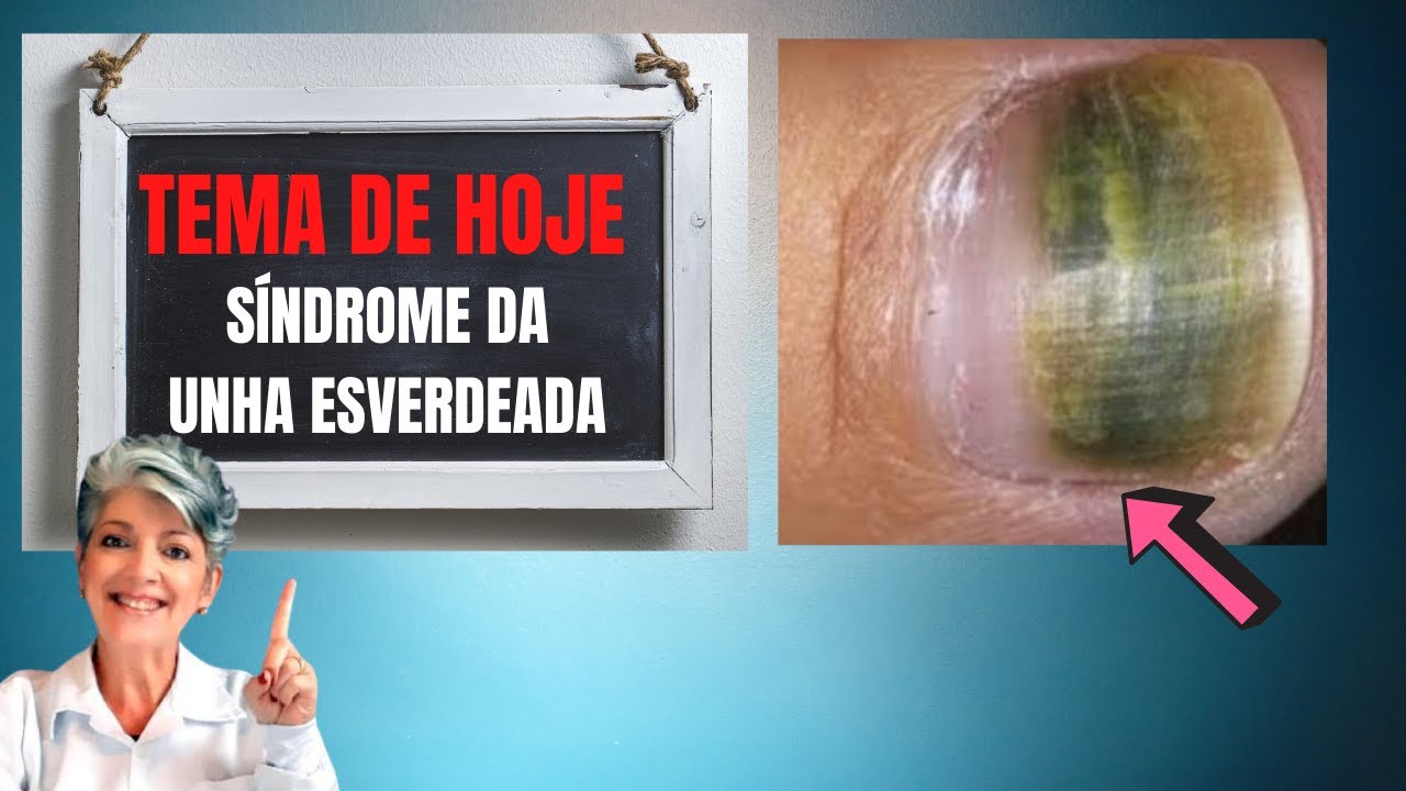 Aulão | Síndrome Da Unha Esverdeada