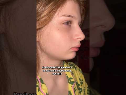 Overjet Explained and How We Fix It!