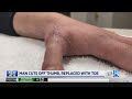 Doctors use man’s toe to recreate sawed-off thumb