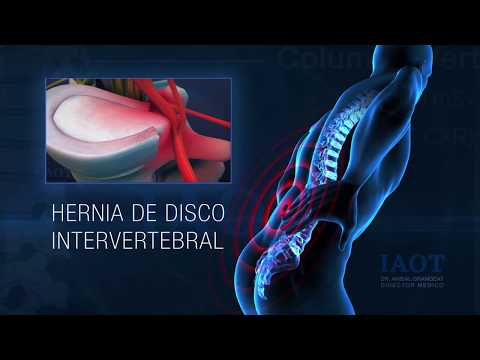 Hernia de disco IAOT