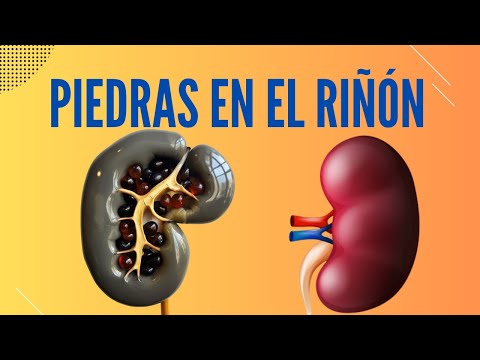 What are kidney stones?