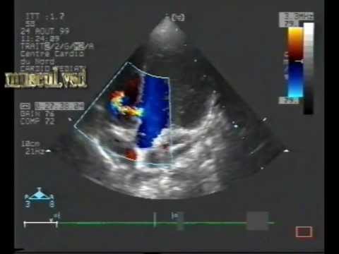 Muscular Ventricular Septal Defect (VSD)