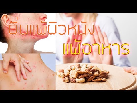 Bifidum โรคสะเก็ดเงิน โรคสะเก็ดเงินครีมสัตวแพทย์