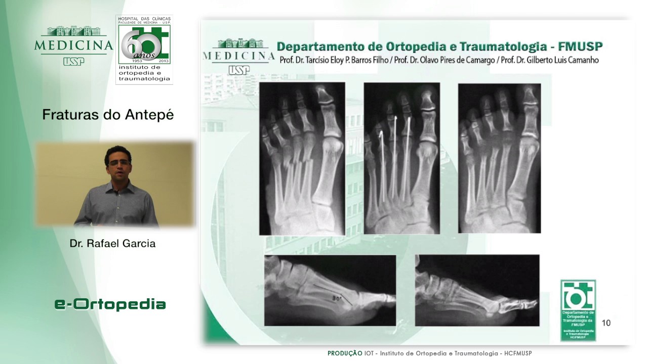 Fraturas do Antepé - Dr. Rafael Garcia