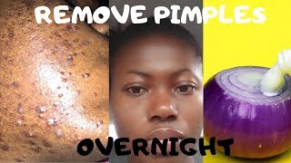 How To Remove Pimples Overnight | Acne Treatment | With Onions