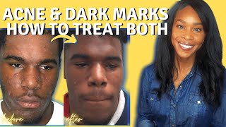 ACNE AND HYPERPIGMENTATION TREATMENT