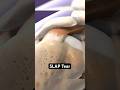 SLAP Tear: When Your Shoulder Labrum Rips